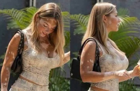 Muchacha muestra con sin complejos su cuerpo marcado por el vitíligo